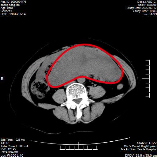 CT檢查提示的巨大腫瘤.jpg