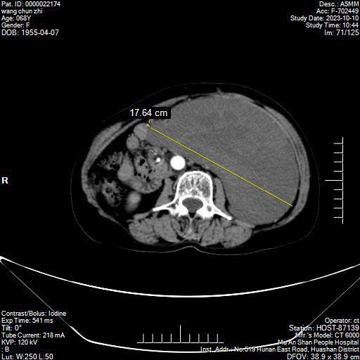 CT檢查影像中黃色線提示腫瘤最長(zhǎng)徑.jpg